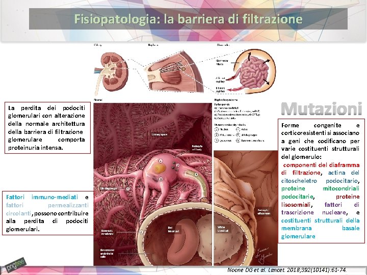 Fisiopatologia: la barriera di filtrazione La perdita dei podociti glomerulari con alterazione della normale