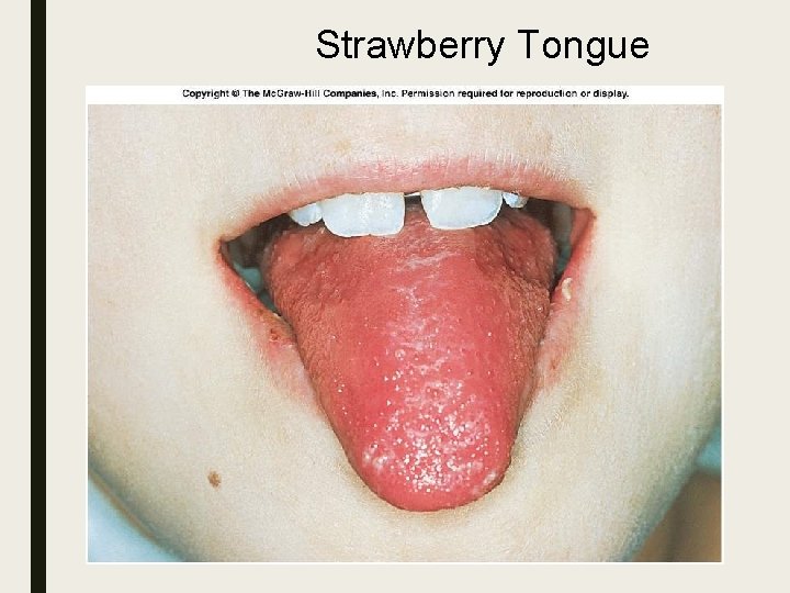 Strawberry Tongue Strawberry Tongue