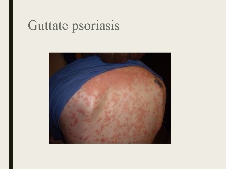 Guttate psoriasis Guttate psoriasis
