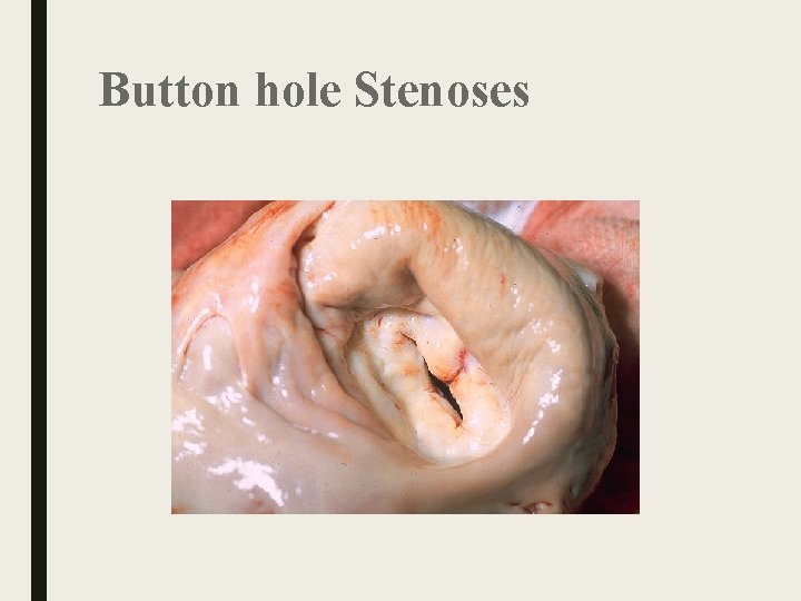 Button hole Stenoses Button hole Stenoses