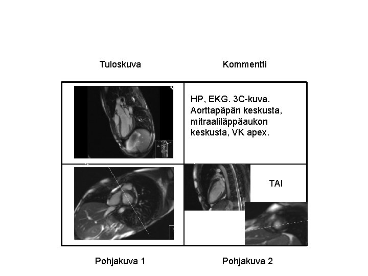 Tuloskuva Kommentti HP, EKG. 3 C-kuva. Aorttapäpän keskusta, mitraaliläppäaukon keskusta, VK apex. TAI Pohjakuva