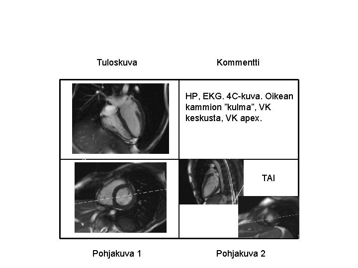 Tuloskuva Kommentti HP, EKG. 4 C-kuva. Oikean kammion ”kulma”, VK keskusta, VK apex. TAI