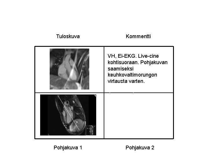 Tuloskuva Kommentti VH, Ei-EKG. Live-cine kohtisuoraan. Pohjakuvan saamiseksi keuhkovaltimorungon virtausta varten. Pohjakuva 1 Pohjakuva