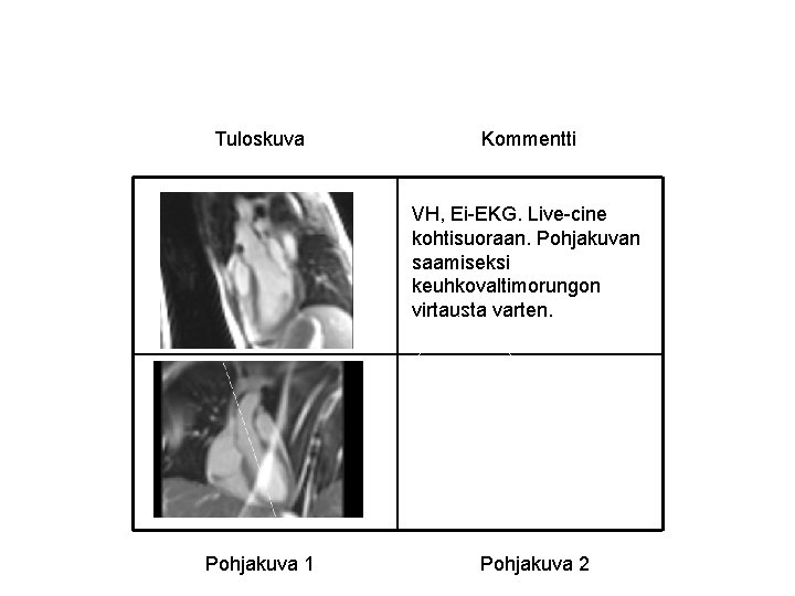 Tuloskuva Kommentti VH, Ei-EKG. Live-cine kohtisuoraan. Pohjakuvan saamiseksi keuhkovaltimorungon virtausta varten. Pohjakuva 1 Pohjakuva Tuloskuva Kommentti VH, Ei-EKG. Live-cine kohtisuoraan. Pohjakuvan saamiseksi keuhkovaltimorungon virtausta varten. Pohjakuva 1 Pohjakuva