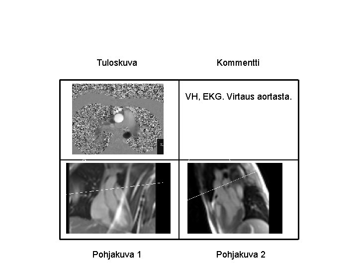 Tuloskuva Kommentti VH, EKG. Virtaus aortasta. Pohjakuva 1 Pohjakuva 2 Tuloskuva Kommentti VH, EKG. Virtaus aortasta. Pohjakuva 1 Pohjakuva 2
