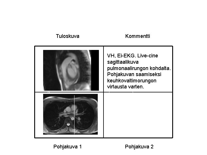 Tuloskuva Kommentti VH, Ei-EKG. Live-cine sagittaalikuva pulmonaalirungon kohdalta. Pohjakuvan saamiseksi keuhkovaltimorungon virtausta varten. Pohjakuva Tuloskuva Kommentti VH, Ei-EKG. Live-cine sagittaalikuva pulmonaalirungon kohdalta. Pohjakuvan saamiseksi keuhkovaltimorungon virtausta varten. Pohjakuva