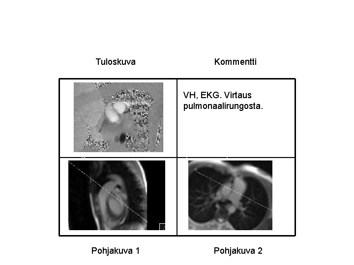 Tuloskuva Kommentti VH, EKG. Virtaus pulmonaalirungosta. Pohjakuva 1 Pohjakuva 2 