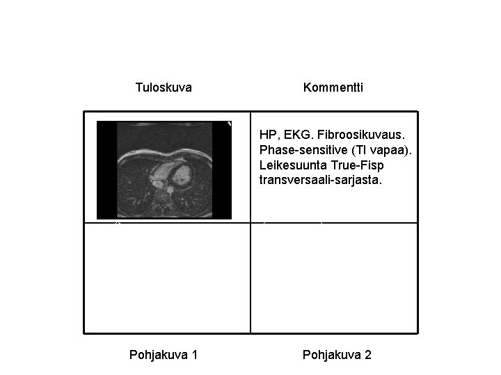 Tuloskuva Kommentti HP, EKG. Fibroosikuvaus. Phase-sensitive (TI vapaa). Leikesuunta True-Fisp transversaali-sarjasta. Pohjakuva 1 Pohjakuva