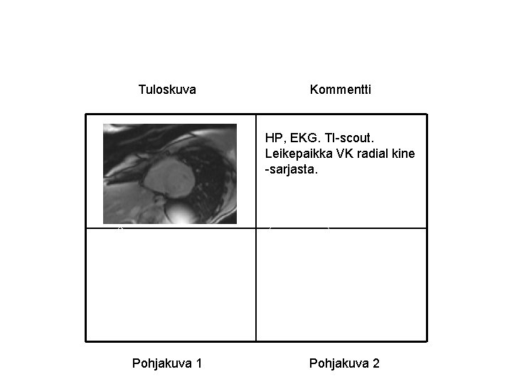 Tuloskuva Kommentti HP, EKG. TI-scout. Leikepaikka VK radial kine -sarjasta. Pohjakuva 1 Pohjakuva 2 Tuloskuva Kommentti HP, EKG. TI-scout. Leikepaikka VK radial kine -sarjasta. Pohjakuva 1 Pohjakuva 2