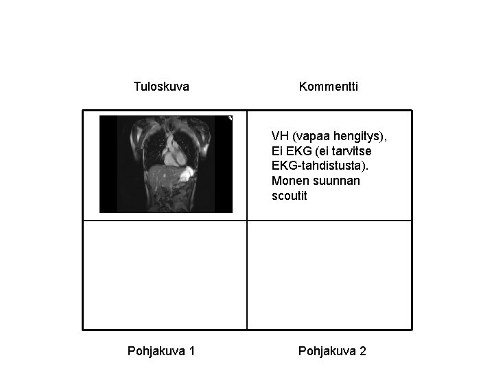 Tuloskuva Kommentti VH (vapaa hengitys), Ei EKG (ei tarvitse EKG-tahdistusta). Monen suunnan scoutit Pohjakuva