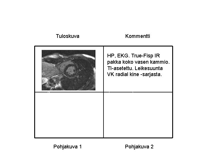 Tuloskuva Kommentti HP, EKG. True-Fisp IR pakka koko vasen kammio. TI-asetettu. Leikesuunta VK radial