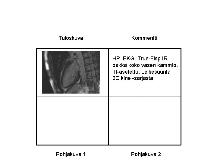 Tuloskuva Kommentti HP, EKG. True-Fisp IR pakka koko vasen kammio. TI-asetettu. Leikesuunta 2 C