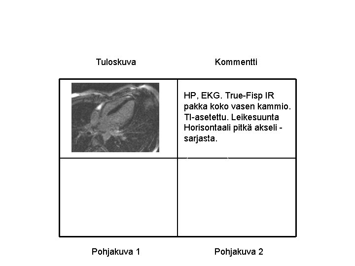 Tuloskuva Kommentti HP, EKG. True-Fisp IR pakka koko vasen kammio. TI-asetettu. Leikesuunta Horisontaali pitkä