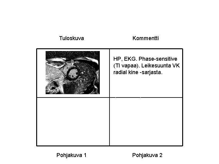 Tuloskuva Kommentti HP, EKG. Phase-sensitive (TI vapaa). Leikesuunta VK radial kine -sarjasta. Pohjakuva 1 Tuloskuva Kommentti HP, EKG. Phase-sensitive (TI vapaa). Leikesuunta VK radial kine -sarjasta. Pohjakuva 1