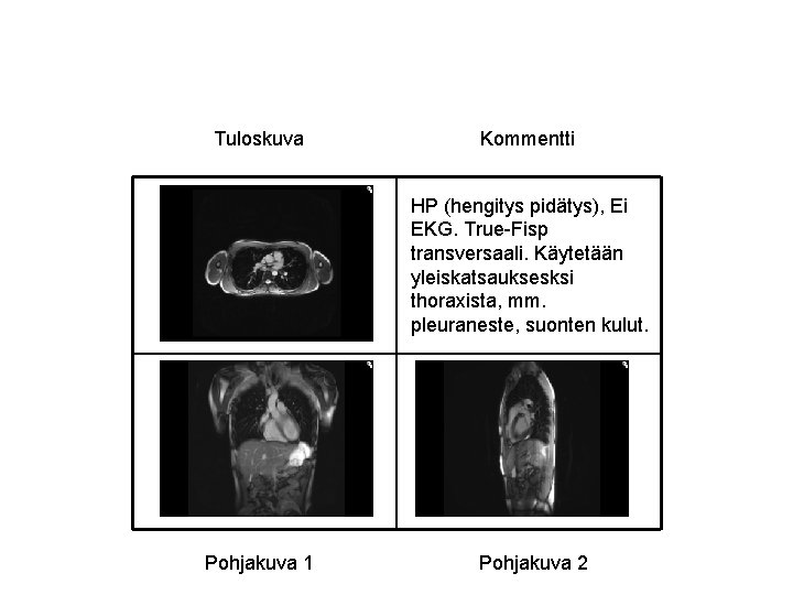 Tuloskuva Kommentti HP (hengitys pidätys), Ei EKG. True-Fisp transversaali. Käytetään yleiskatsauksesksi thoraxista, mm. pleuraneste,