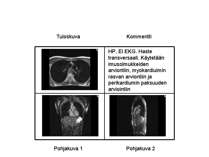 Tuloskuva Kommentti HP, Ei EKG. Haste transversaali. Käytetään imusolmukkeiden arviontiin, myokardiuimin rasvan arviontiin ja Tuloskuva Kommentti HP, Ei EKG. Haste transversaali. Käytetään imusolmukkeiden arviontiin, myokardiuimin rasvan arviontiin ja