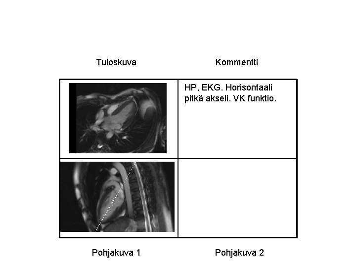 Tuloskuva Kommentti HP, EKG. Horisontaali pitkä akseli. VK funktio. Pohjakuva 1 Pohjakuva 2 