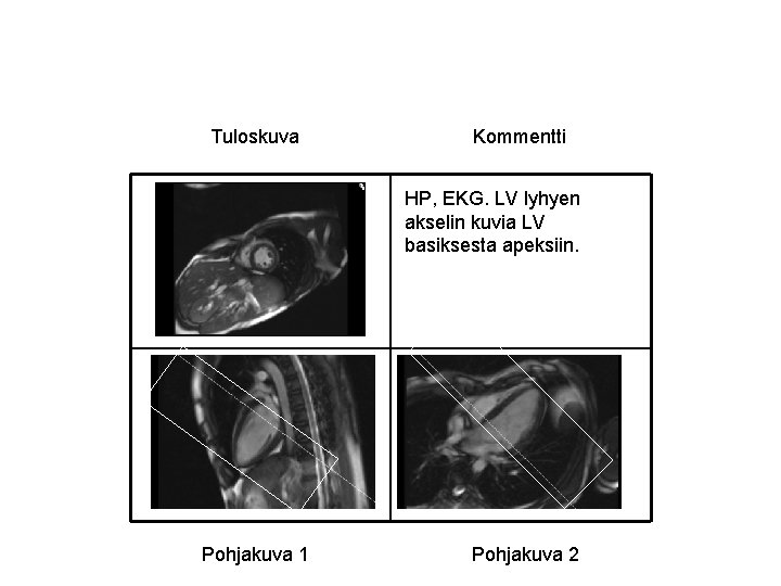 Tuloskuva Kommentti HP, EKG. LV lyhyen akselin kuvia LV basiksesta apeksiin. Pohjakuva 1 Pohjakuva