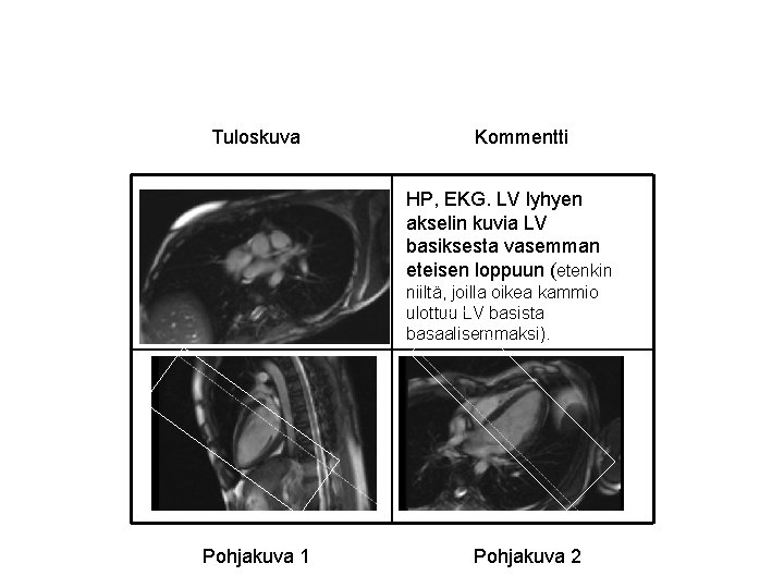 Tuloskuva Kommentti HP, EKG. LV lyhyen akselin kuvia LV basiksesta vasemman eteisen loppuun (etenkin Tuloskuva Kommentti HP, EKG. LV lyhyen akselin kuvia LV basiksesta vasemman eteisen loppuun (etenkin