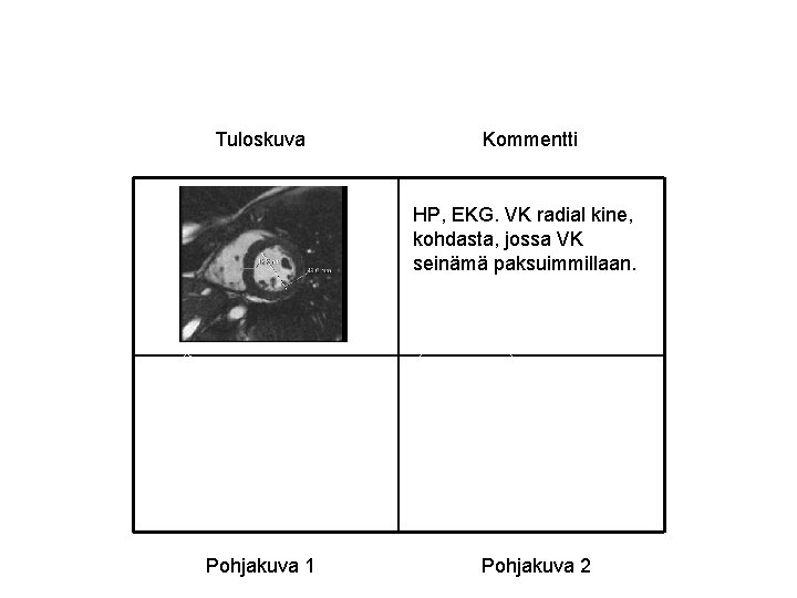 Tuloskuva Kommentti HP, EKG. VK radial kine, kohdasta, jossa VK seinämä paksuimmillaan. Pohjakuva 1