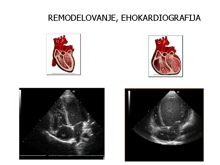 REMODELOVANJE, EHOKARDIOGRAFIJA 