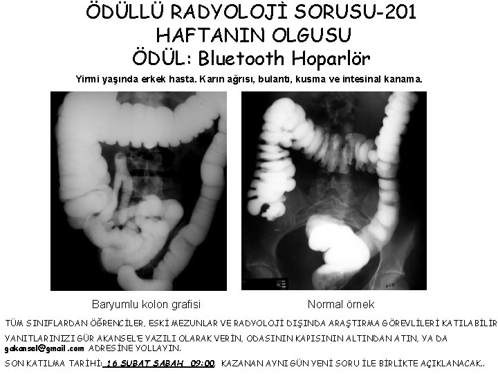 ÖDÜLLÜ RADYOLOJİ SORUSU-201 HAFTANIN OLGUSU ÖDÜL: Bluetooth Hoparlör Yirmi yaşında erkek hasta. Karın ağrısı,