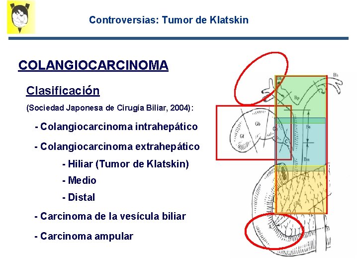 Controversias: Tumor de Klatskin COLANGIOCARCINOMA Clasificación (Sociedad Japonesa de Cirugía Biliar, 2004): - Colangiocarcinoma