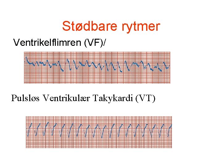 Stødbare rytmer Ventrikelflimren (VF)/ Pulsløs Ventrikulær Takykardi (VT) Stødbare rytmer Ventrikelflimren (VF)/ Pulsløs Ventrikulær Takykardi (VT)