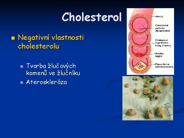 Cholesterol n Negativní vlastnosti cholesterolu n n Tvorba žlučových kamenů ve žlučníku Ateroskleróza 