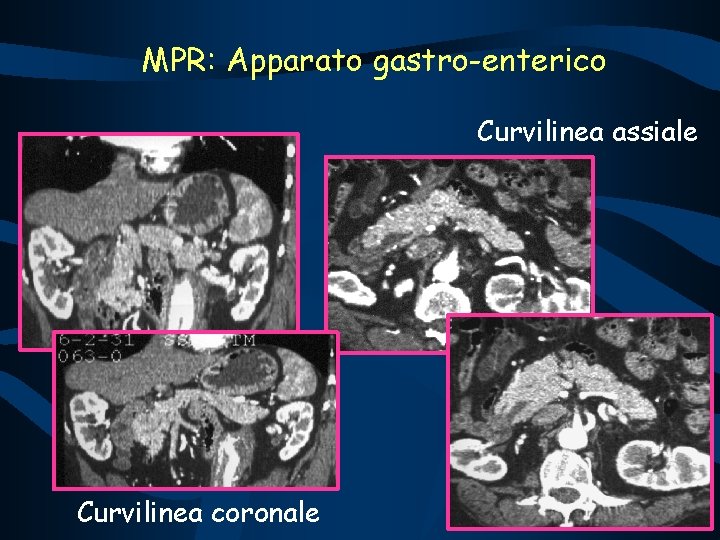 MPR: Apparato gastro-enterico Curvilinea assiale Curvilinea coronale 