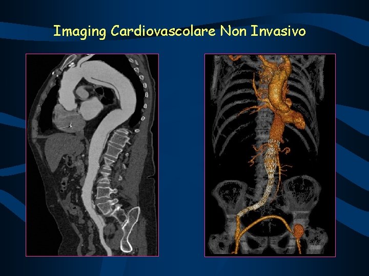 Imaging Cardiovascolare Non Invasivo 