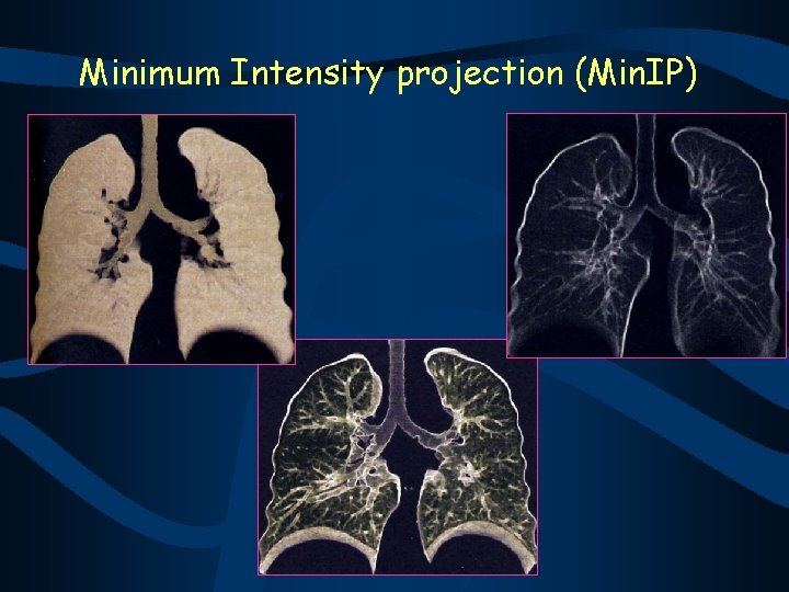 Minimum Intensity projection (Min. IP) 