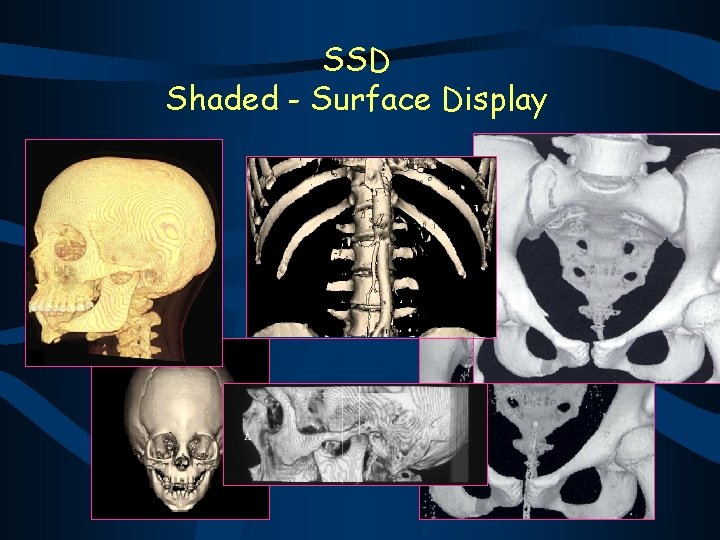 SSD Shaded - Surface Display 
