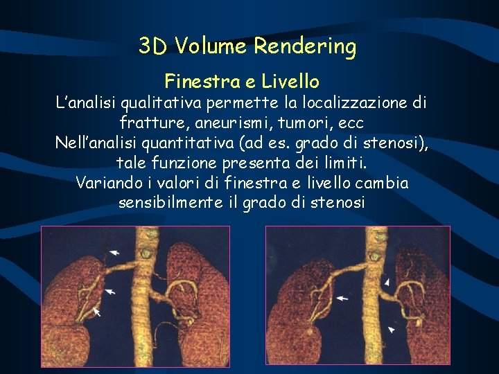 3 D Volume Rendering Finestra e Livello L’analisi qualitativa permette la localizzazione di fratture,
