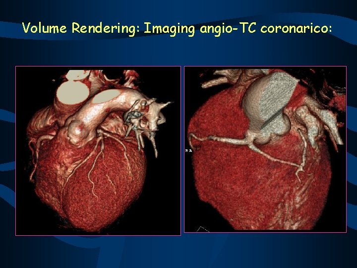 Volume Rendering: Imaging angio-TC coronarico: 