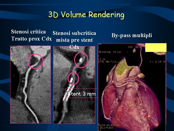 3 D Volume Rendering Stenosi critica Stenosi subcritica Tratto prox Cdx mista pre stent