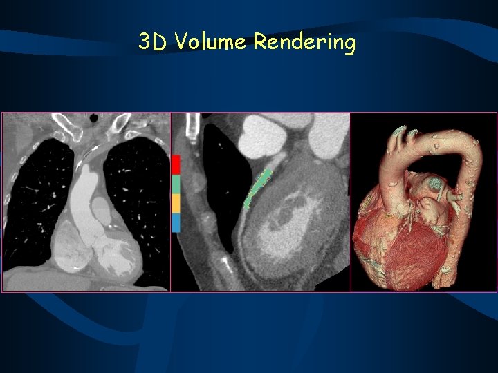 3 D Volume Rendering 