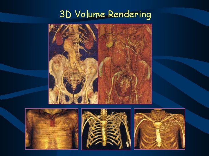 3 D Volume Rendering 