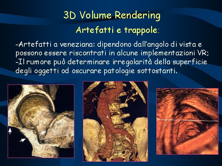 3 D Volume Rendering Artefatti e trappole: -Artefatti a veneziana: dipendono dall’angolo di vista