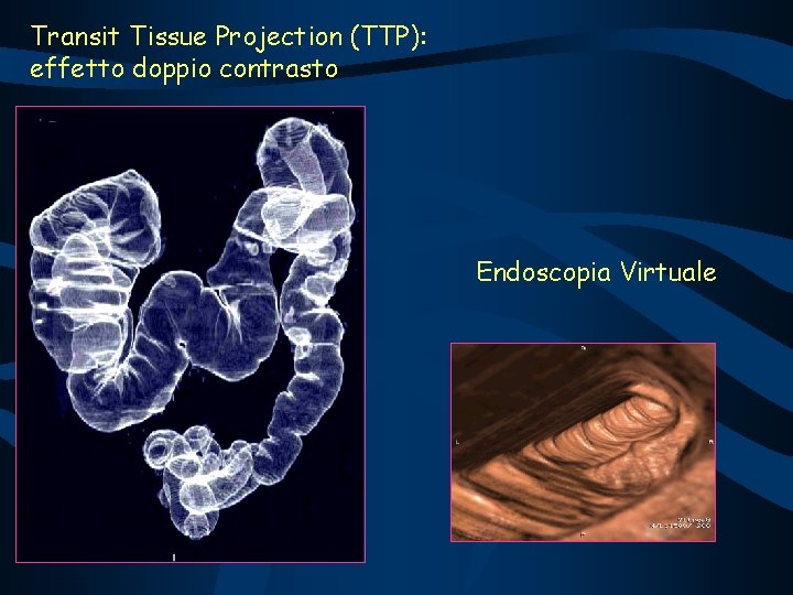 Transit Tissue Projection (TTP): effetto doppio contrasto Endoscopia Virtuale 