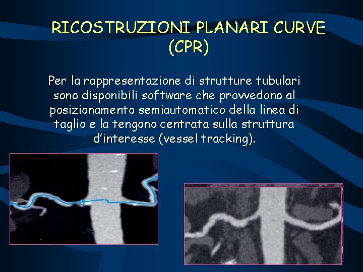 RICOSTRUZIONI PLANARI CURVE (CPR) Per la rappresentazione di strutture tubulari sono disponibili software che