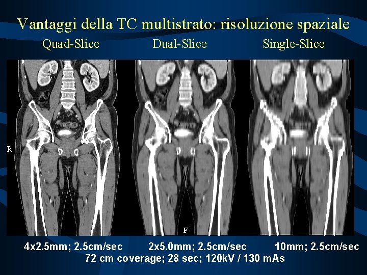 Vantaggi della TC multistrato: risoluzione spaziale Quad-Slice Dual-Slice Single-Slice 4 x 2. 5 mm;