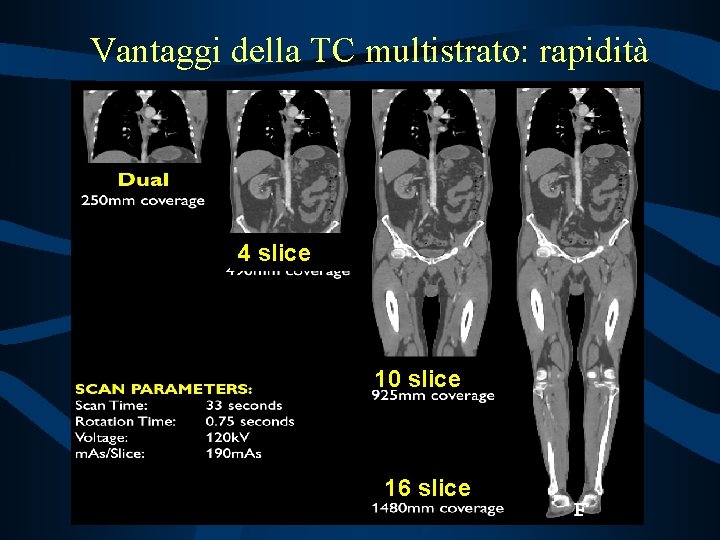 Vantaggi della TC multistrato: rapidità 4 slice 10 slice 16 slice 