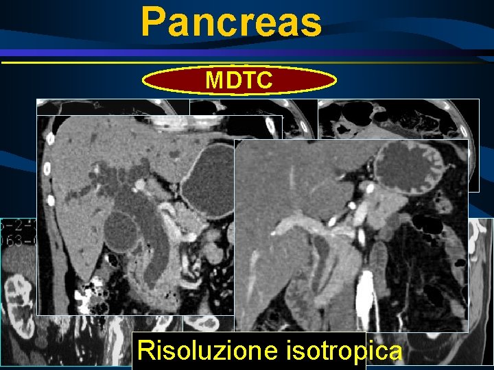 Pancreas MDTC 45 sec 75 sec 5 min Risoluzione isotropica 