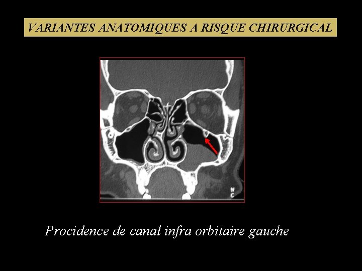 VARIANTES ANATOMIQUES A RISQUE CHIRURGICAL Procidence de canal infra orbitaire gauche 