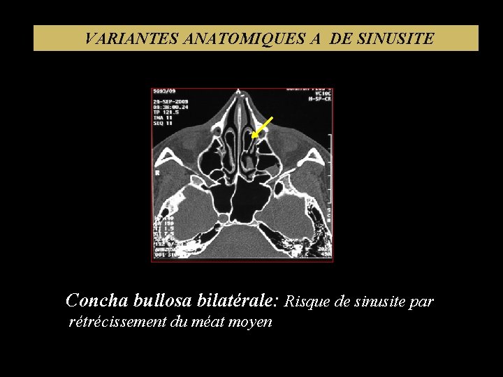 VARIANTES ANATOMIQUES A DE SINUSITE Concha bullosa bilatérale: Risque de sinusite par rétrécissement du