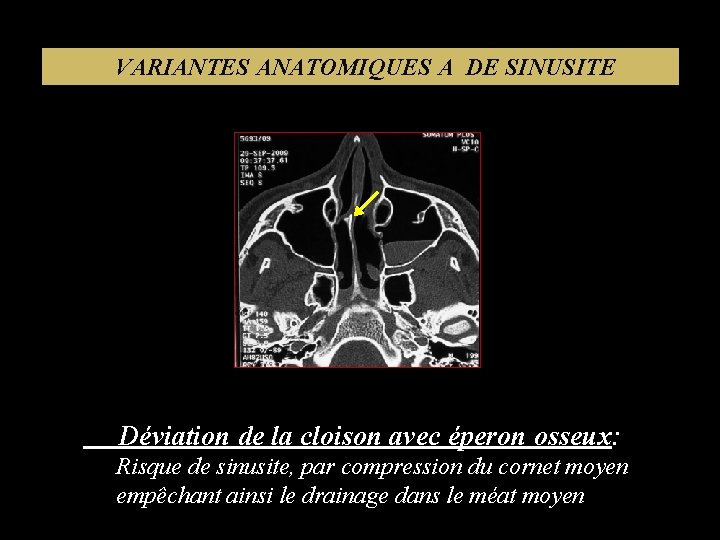 VARIANTES ANATOMIQUES A DE SINUSITE Déviation de la cloison avec éperon osseux: Risque de