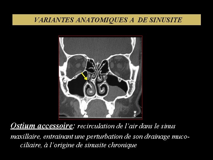 VARIANTES ANATOMIQUES A DE SINUSITE Ostium accessoire: recirculation de l’air dans le sinus maxillaire,