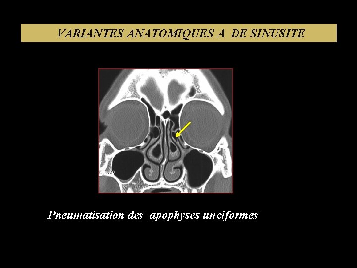 VARIANTES ANATOMIQUES A DE SINUSITE Pneumatisation des apophyses unciformes 