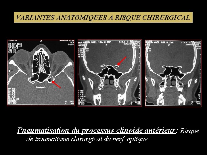 VARIANTES ANATOMIQUES A RISQUE CHIRURGICAL Pneumatisation du processus clinoide antérieur: Risque de traumatisme chirurgical